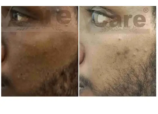 Before & After Dull skin Treatment Results