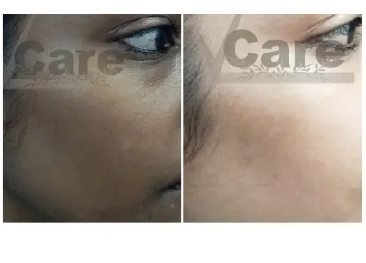 Before & After Dull skin Treatment Results