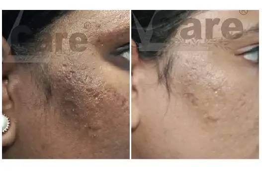 Before & After Dull skin Treatment Results