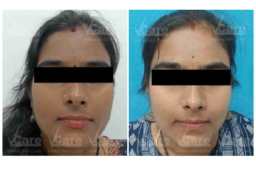 Before & After Exosome Skin Treatment Results
