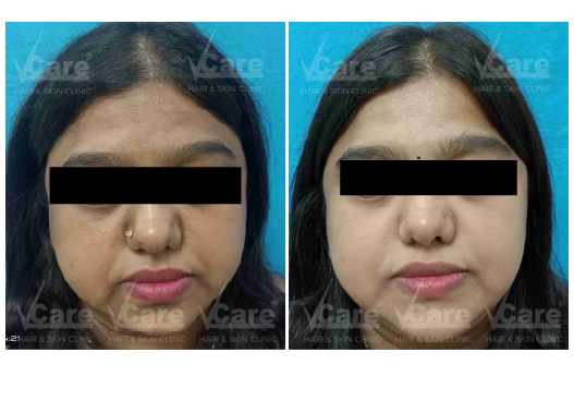 Before & After Exosome Skin Treatment Results