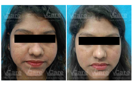 Before & After Exosome Skin Treatment Results