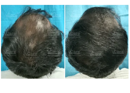 Before & After Exogro Treatment Results