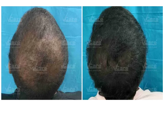 Before & After Exogro Treatment Results