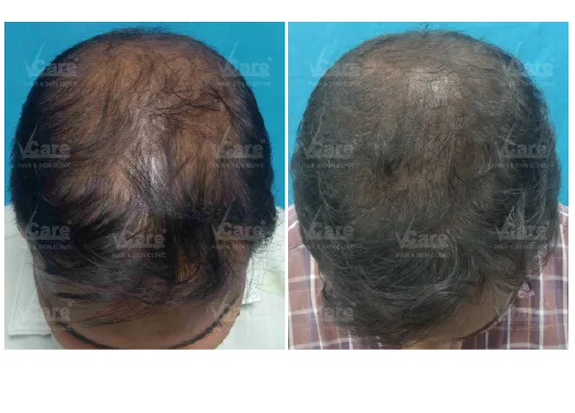 Before & After Exogro Treatment Results