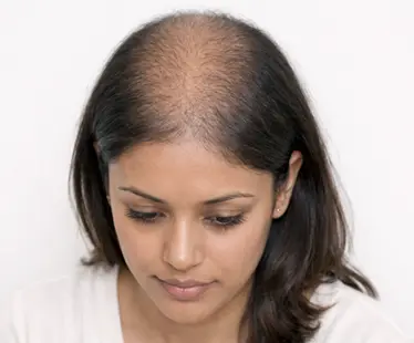 Female Pattern Baldness