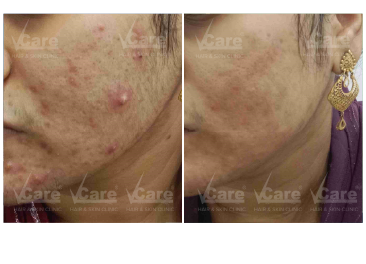 Fractional CO₂ Laser Treatment Before and After