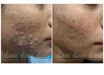 Fractional CO₂ Laser Treatment Before and After