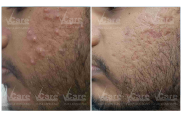 Fractional CO₂ Laser Treatment Before and After