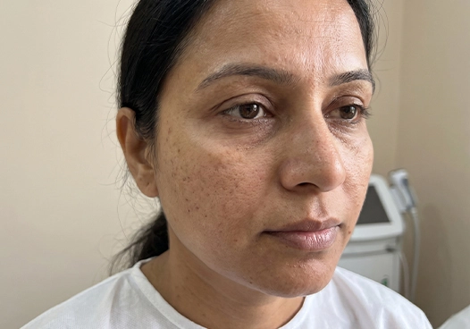 Men and women with acne pits, open pores, scars, or wrinkles