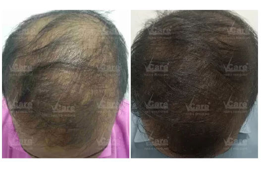 Before & After Hair GFC Hair Treatment Results