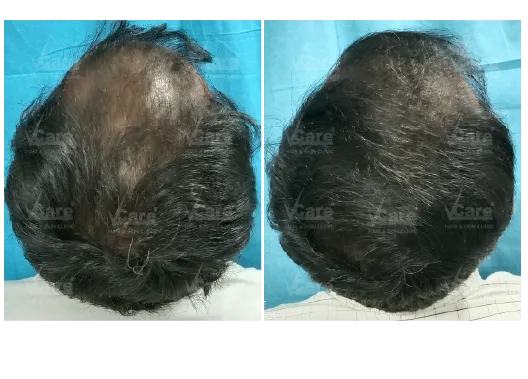 Before & After Hair GFC Hair Treatment Results