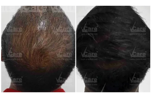 Before & After Hair GFC Hair Treatment Results