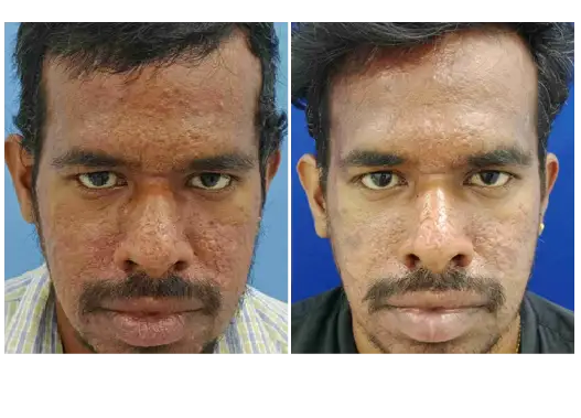 Before & After GFC Skin Treatment Results