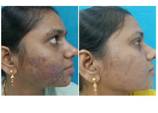 Before & After GFC Skin Treatment Results