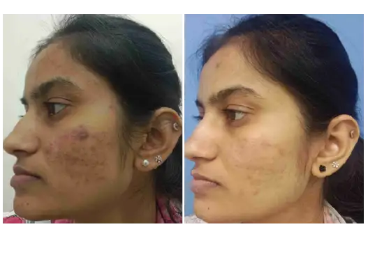 Before & After GFC Skin Treatment Results