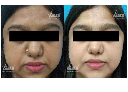 Before & After Glycolic Peel Treatment Results