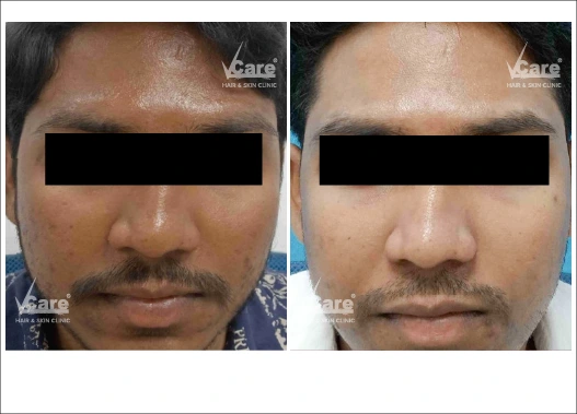 Before & After Glycolic Peel Treatment Results