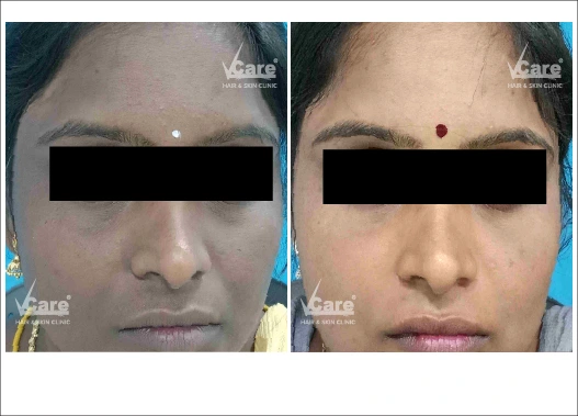 Before & After Glycolic Peel Treatment Results