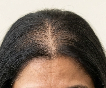 Gradual hair thinning and reduced volume