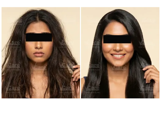 Before & After Hair Breakage & Split Ends Treatment Results