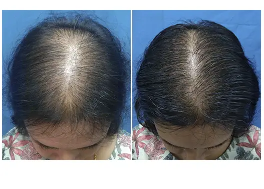 Before & After Hair Fall Treatment Results