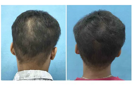 Before & After Hair Fall Treatment Results
