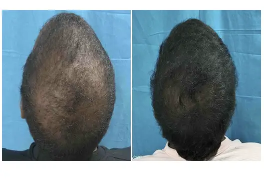 Before & After Hair Fall Treatment Results