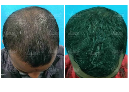 Before & After Hair Transplant Results