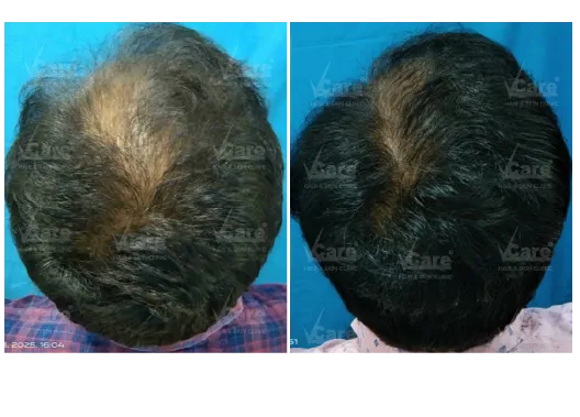 Before & After Hair Transplant Results