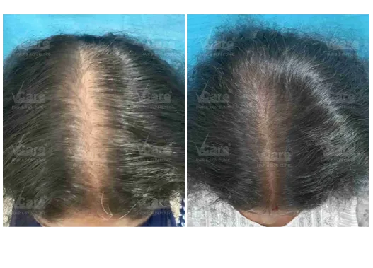 Before & After Hair Transplant Results