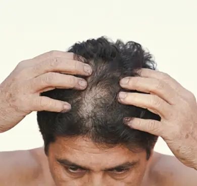 Individuals with dandruff, itchy, or flaky scalp