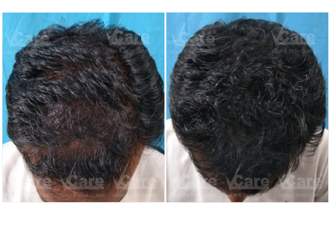 Before & After Hair Rejuvenation Therapy Results