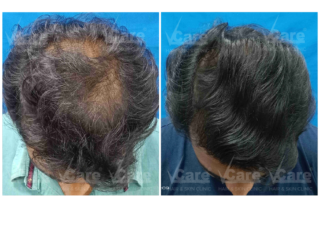Before & After Hair Rejuvenation Therapy Results