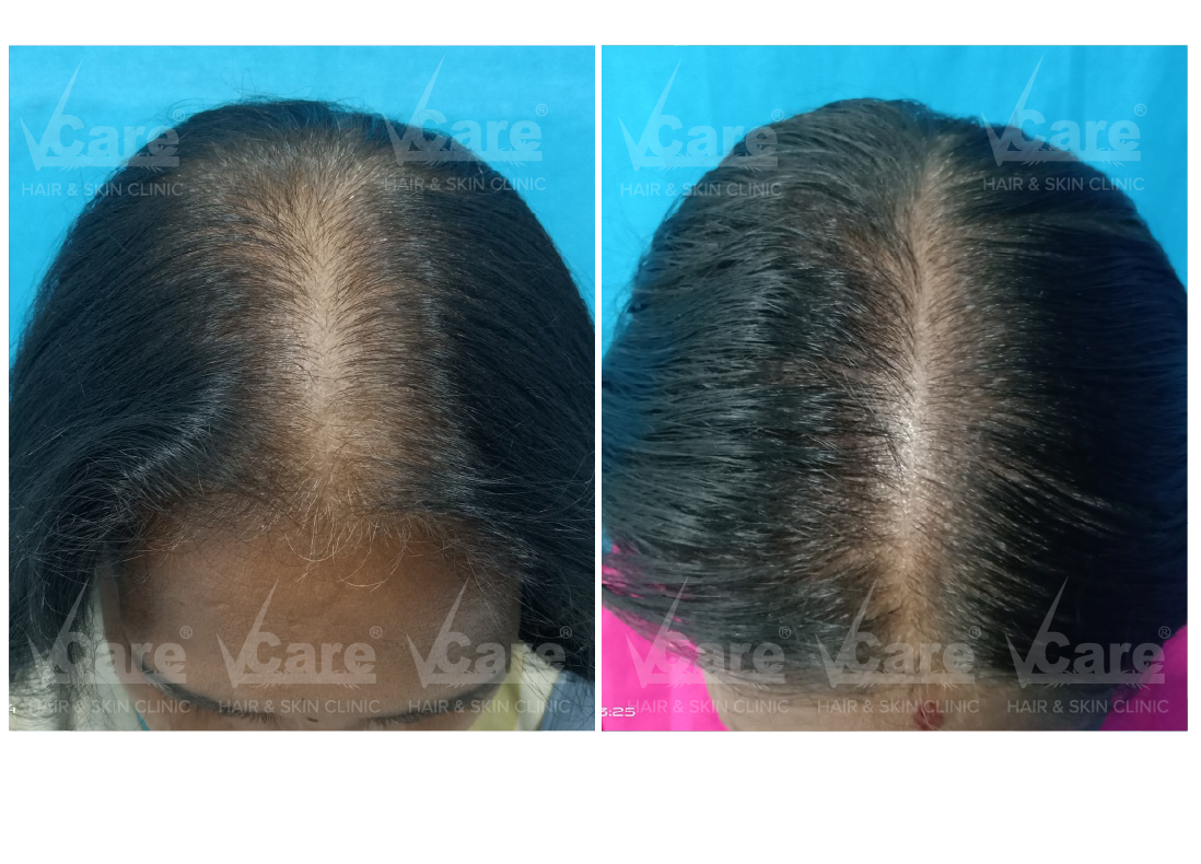 Before & After Hair Rejuvenation Therapy Results