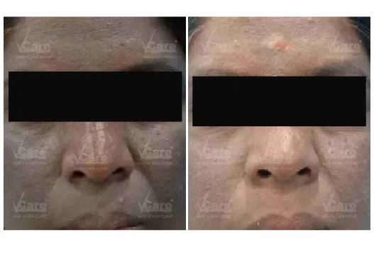 Before & After Lactic Peel Treatment Results