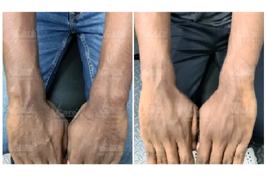 Before & After Lactic Peel Treatment Results