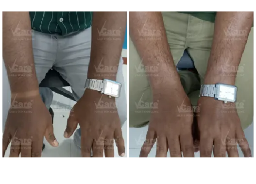 Before & After Lactic Peel Treatment Results