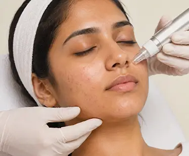 Acne Treatment