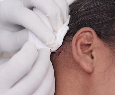Acne Treatment
