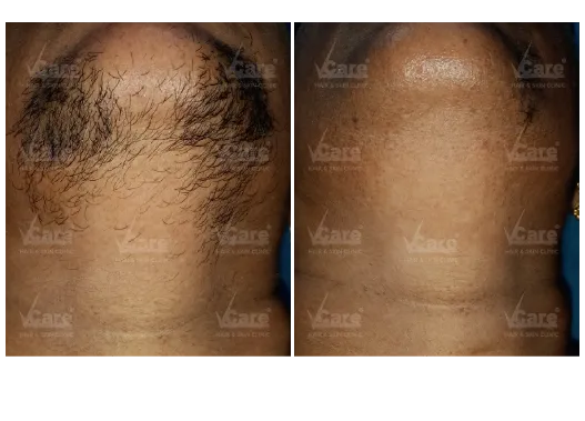 Before & After Laser Hair Removal Treatment Results