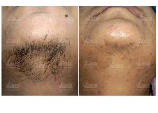 Before & After Laser Hair Removal Treatment Results