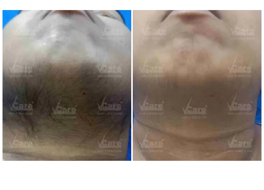 Before & After Laser Hair Removal Treatment Results