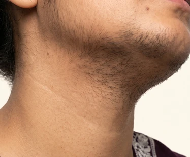 Neck Hair