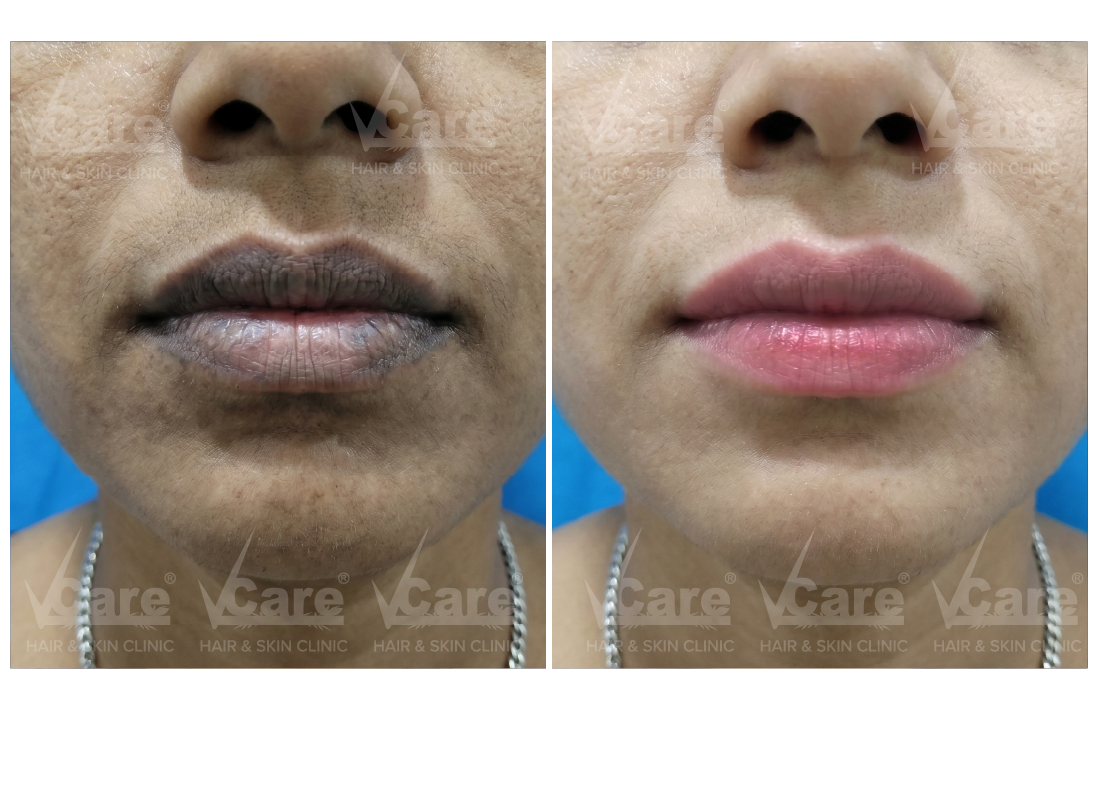 Before & After Q Switch Laser for Lips Results