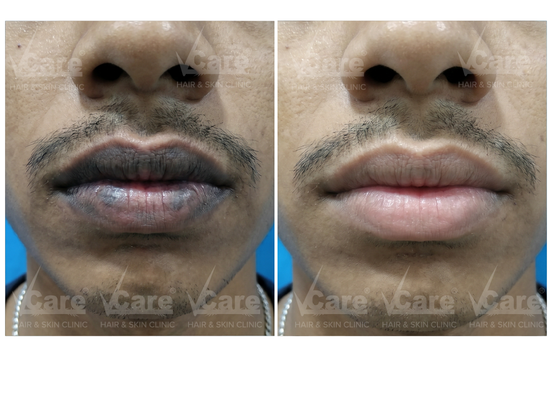 Before & After Q Switch Laser for Lips Results