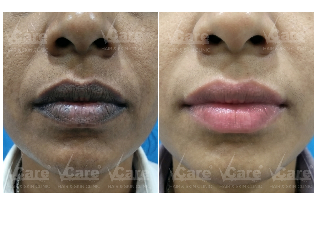 Before & After Q Switch Laser for Lips Results