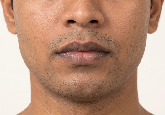 Smoker’s lips or sun-damaged lips