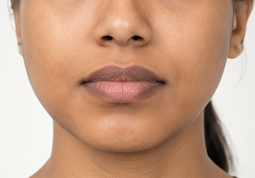Individuals with uneven lip tone or patchy lip pigmentation (suitability assessed on a case-by-case basis)