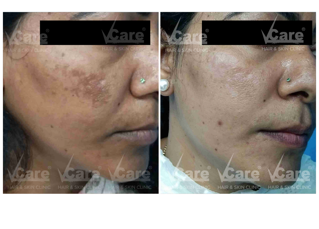 Before & After Melassence Treatment Results